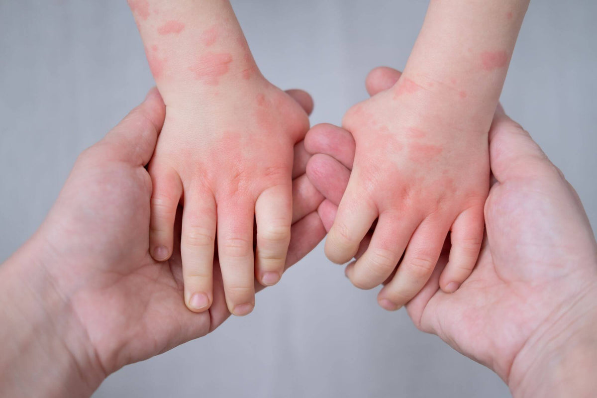 What Causes Eczema in Babies? A Comprehensive Guide for Parents