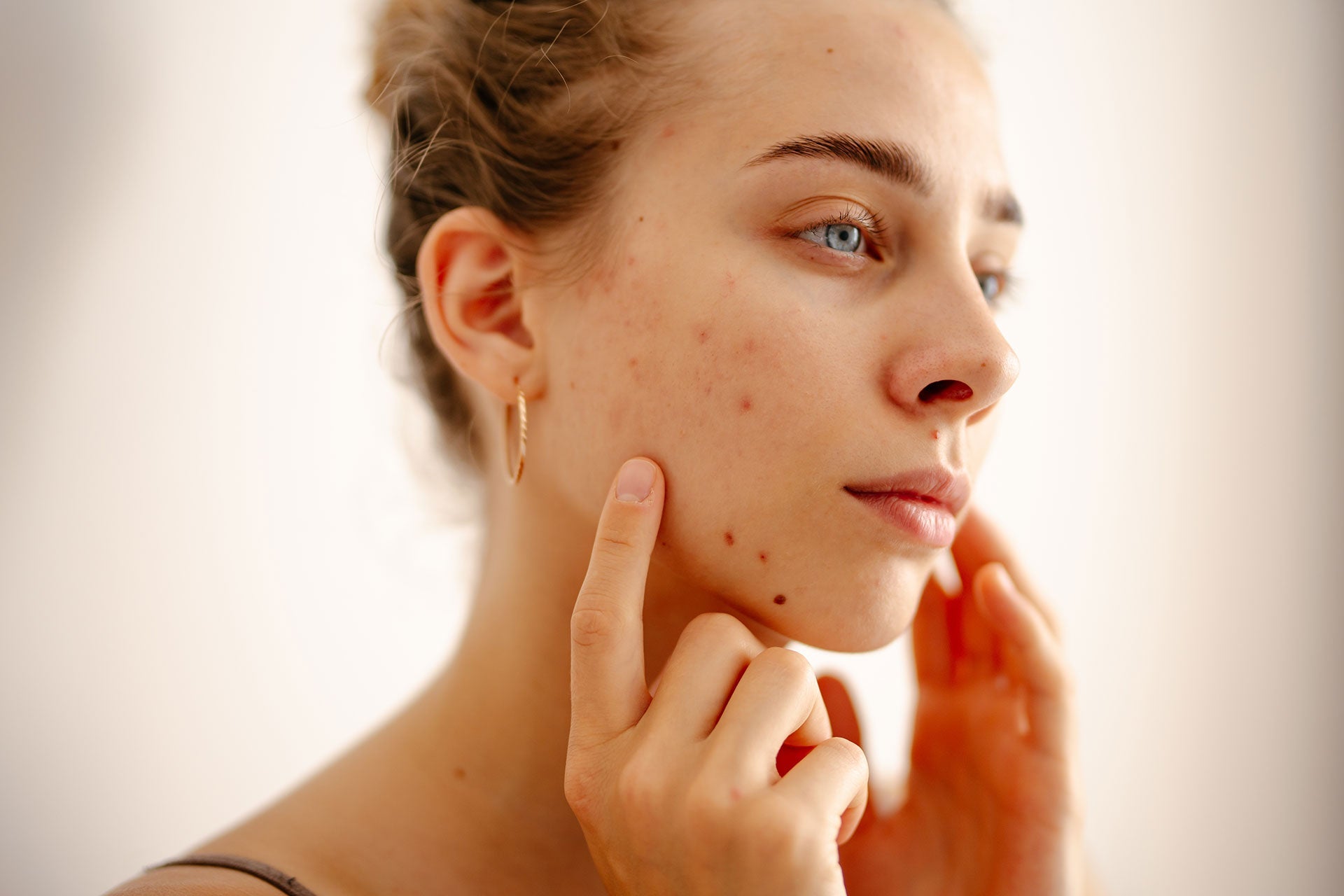 Hormonal Acne in Women: DIM vs. Myo-Inositol vs. Spironolactone, and Why Standard Treatments Often Fall Short