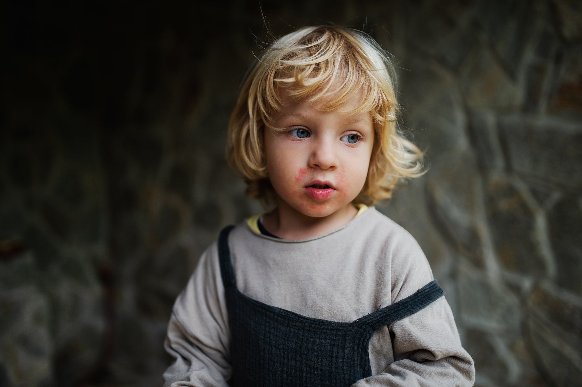 Boy with Eczema on cheeks