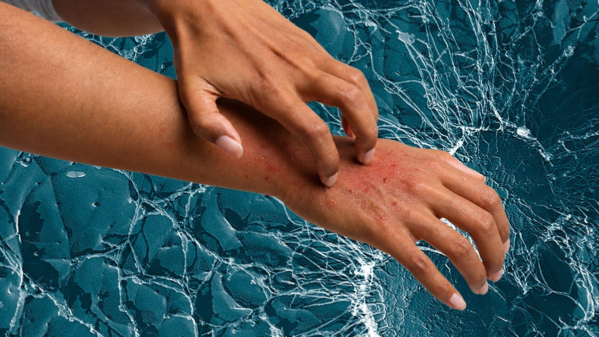 Staph and Eczema: How Staphylococcus aureus Fuels Atopic Dermatitis Flares (and How to Reduce It)