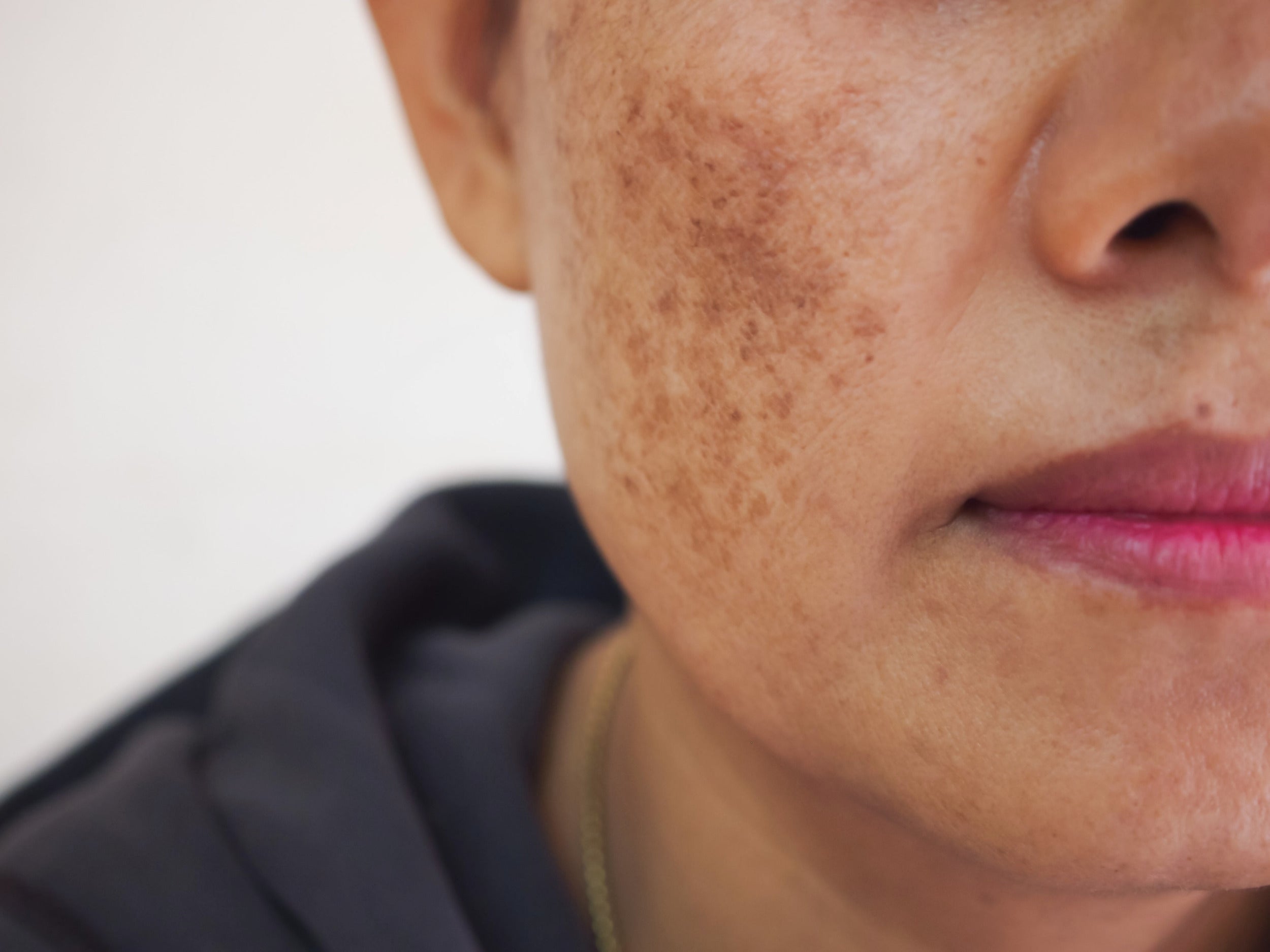 How To Treat Sunspots on Your Face: Effective Tips and Tricks