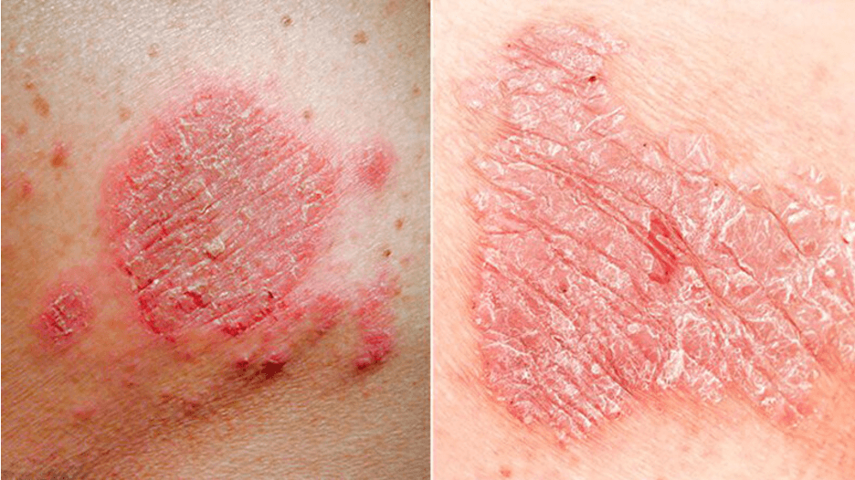Eczema and Prosiasis present differently
