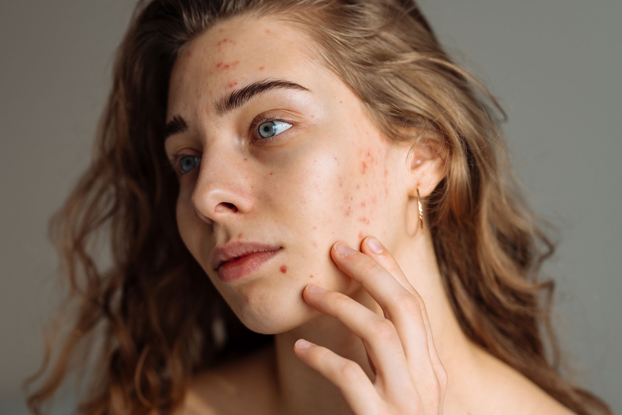 The Dry Skin Dilemma: Does Dry Skin Cause Acne?