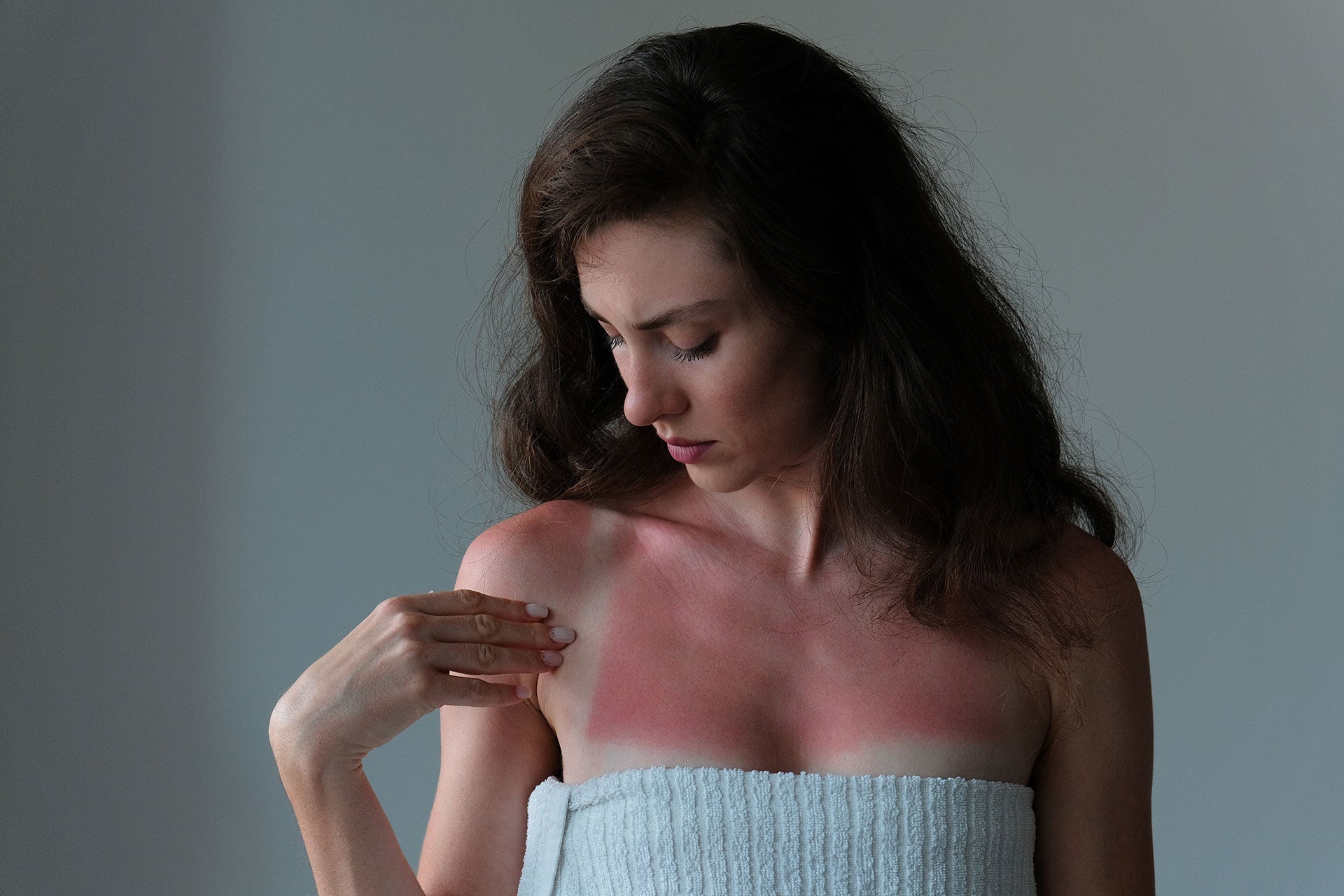 Sunburn and Sensitive Skin: What Really Happens If You Have Eczema, Acne, or Rosacea