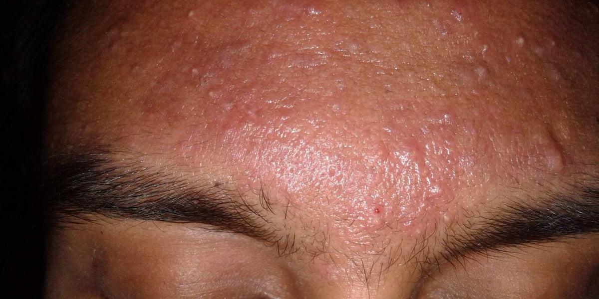 Why Does Acne Flare up in Spring & Summer or with warmer weather?