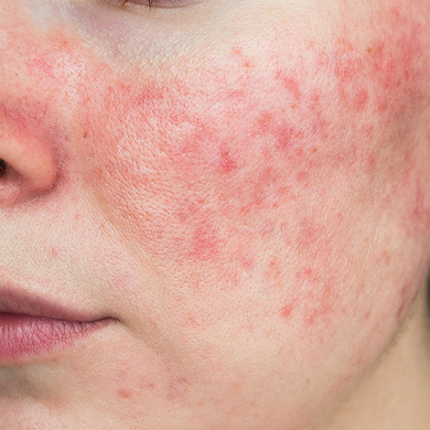 Rosacea