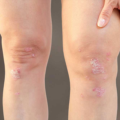 Psoriasis