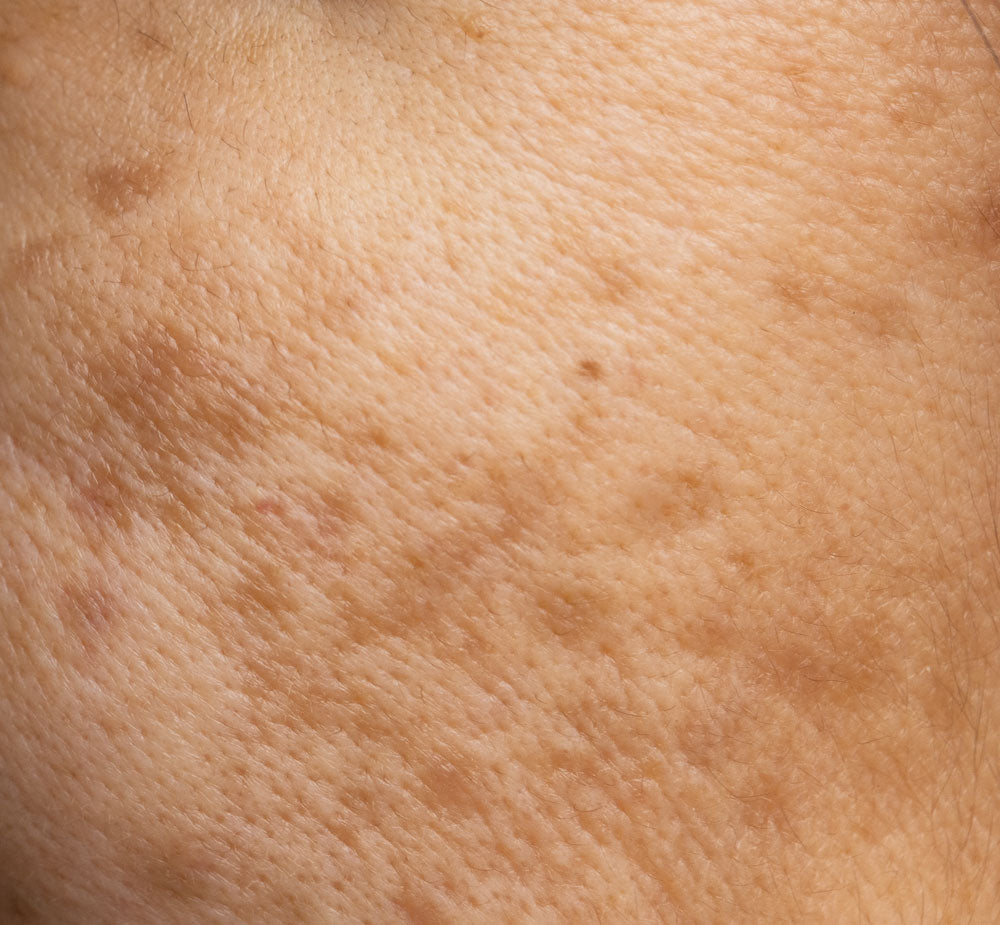 Menopausal Skin