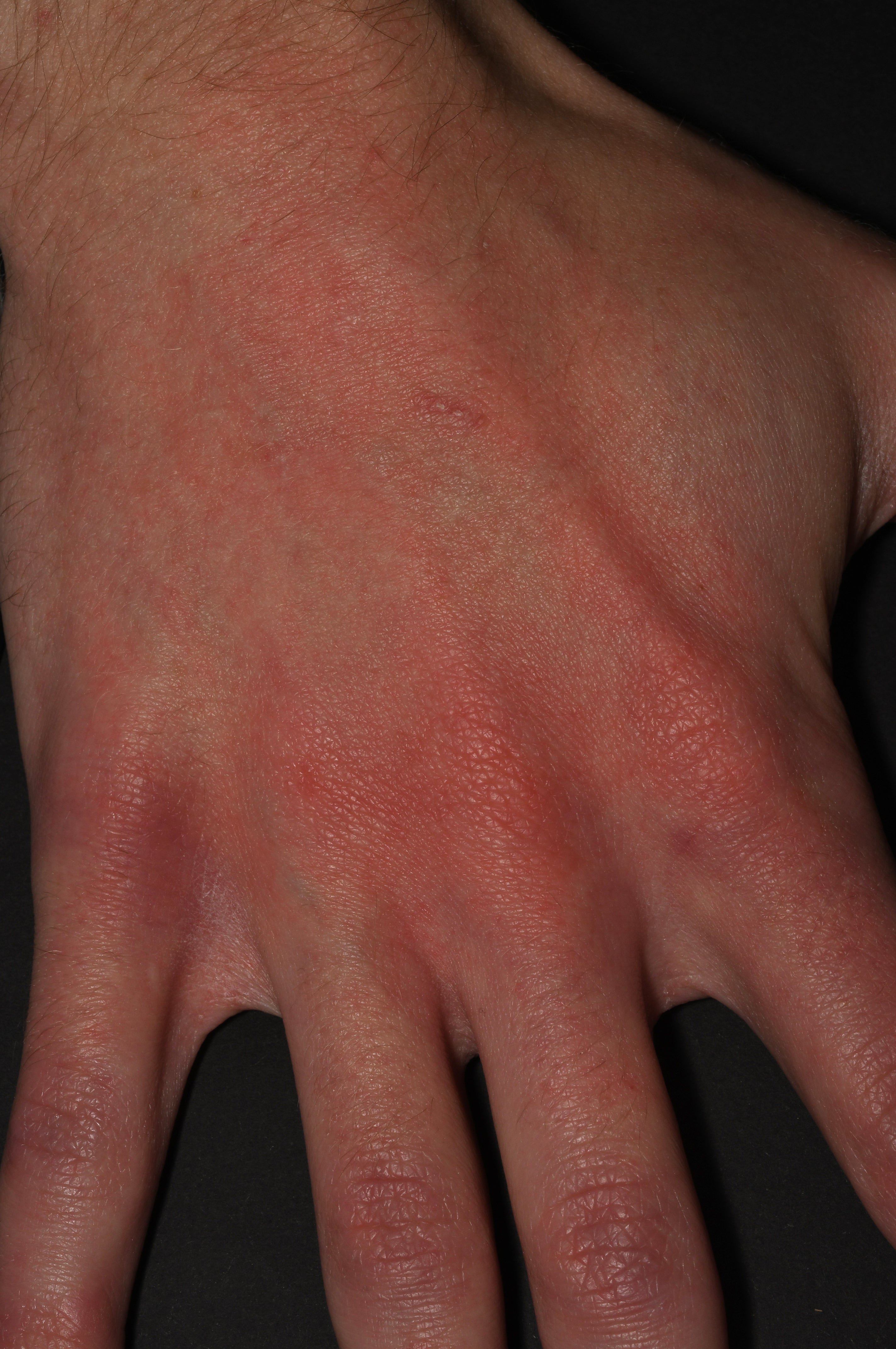Before treatment