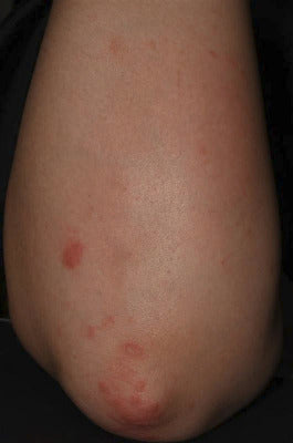 Before treatment