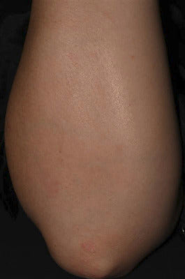After treatment
