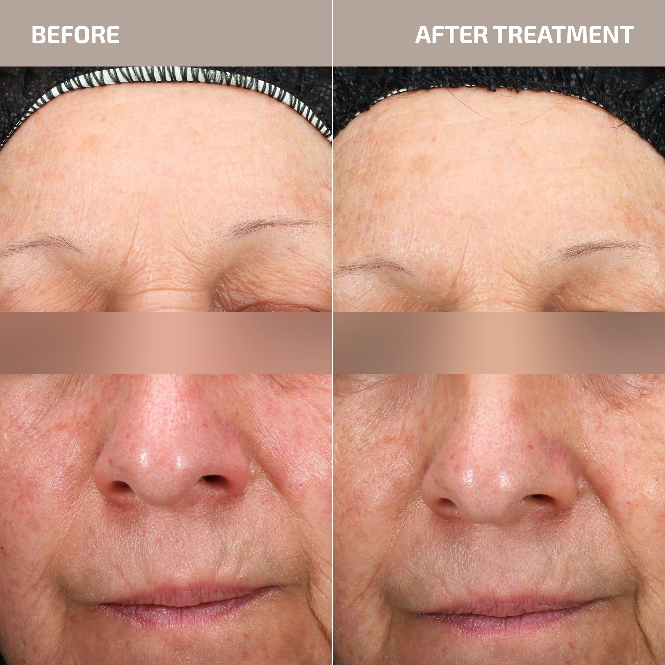 Antu Complexion Protocol - Skin Barrier L-histidine supplement & M3 Antioxidant Serum (Age: 30-60+)