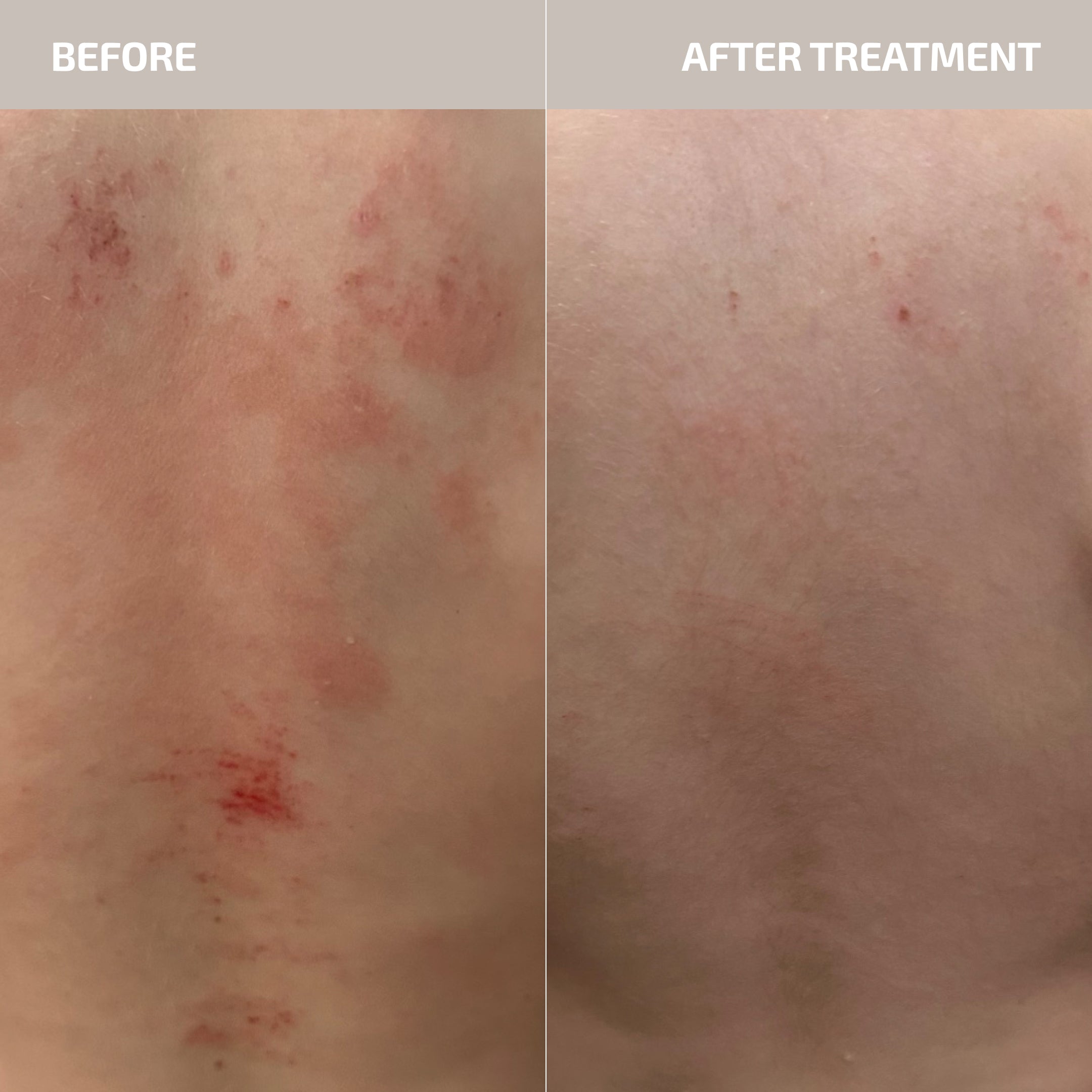ANTÜ Skin Barrier Support Supplement (13+)