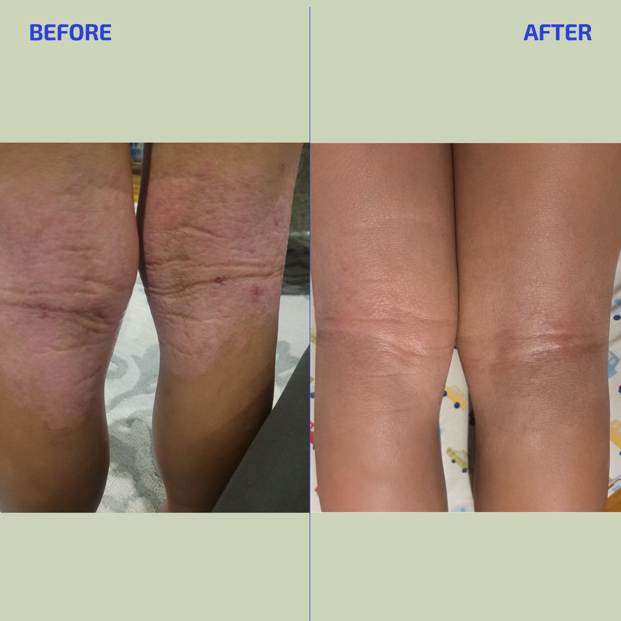 Eczema Relief Lotion