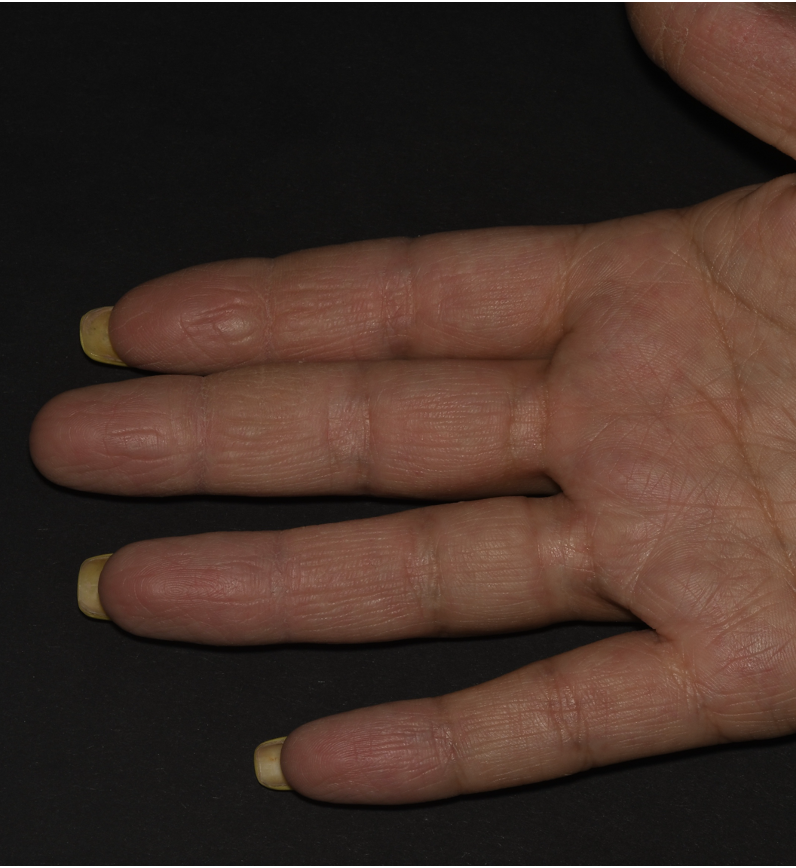 After treatment