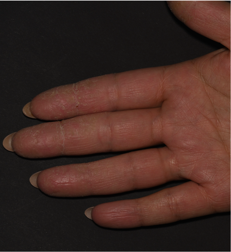 Before treatment