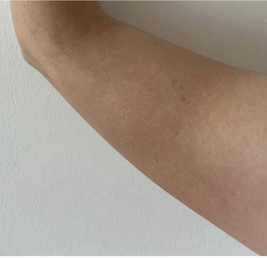 After treatment