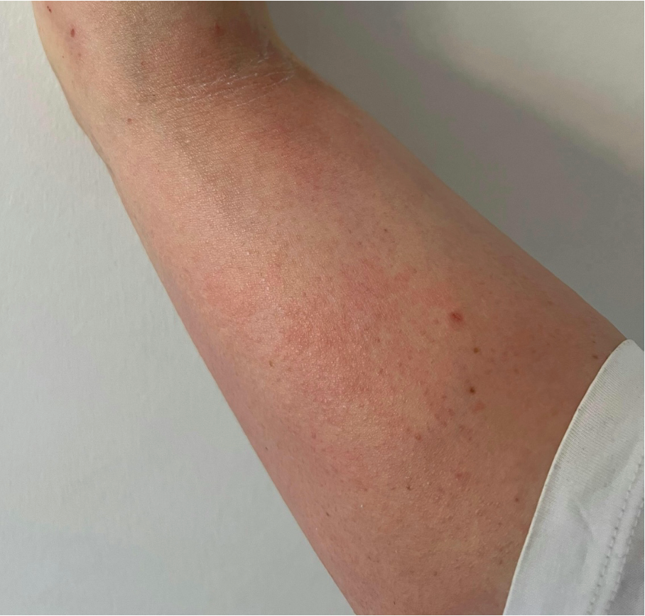 Before treatment