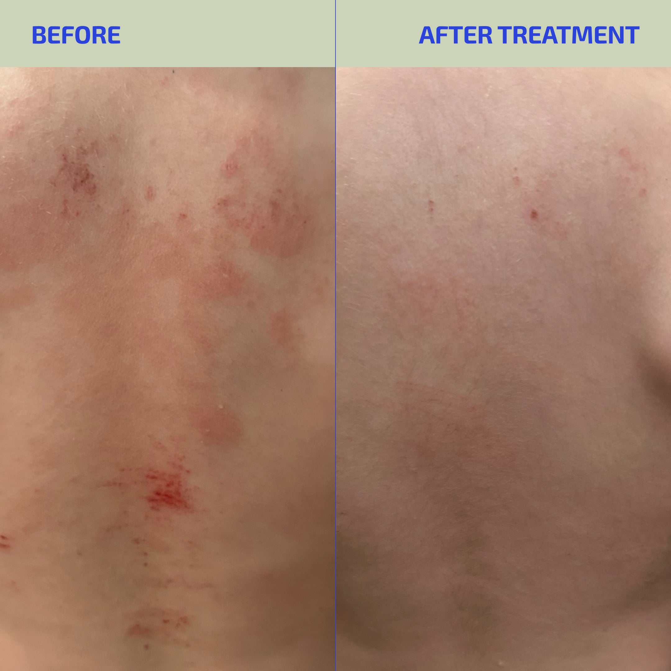 Before and after treatment comparison of skin with visible redness.