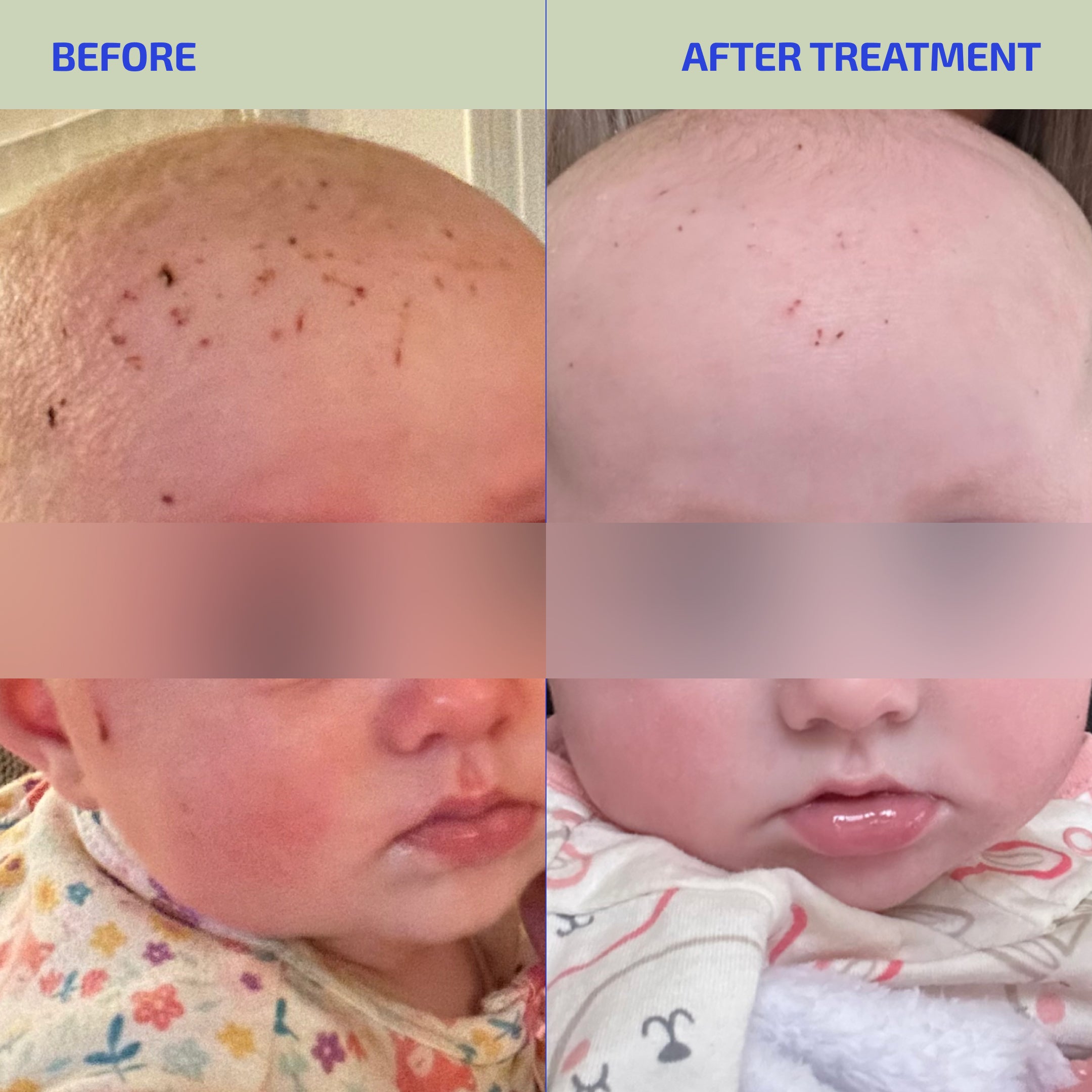 Before and after treatment comparison of a child's skin condition.