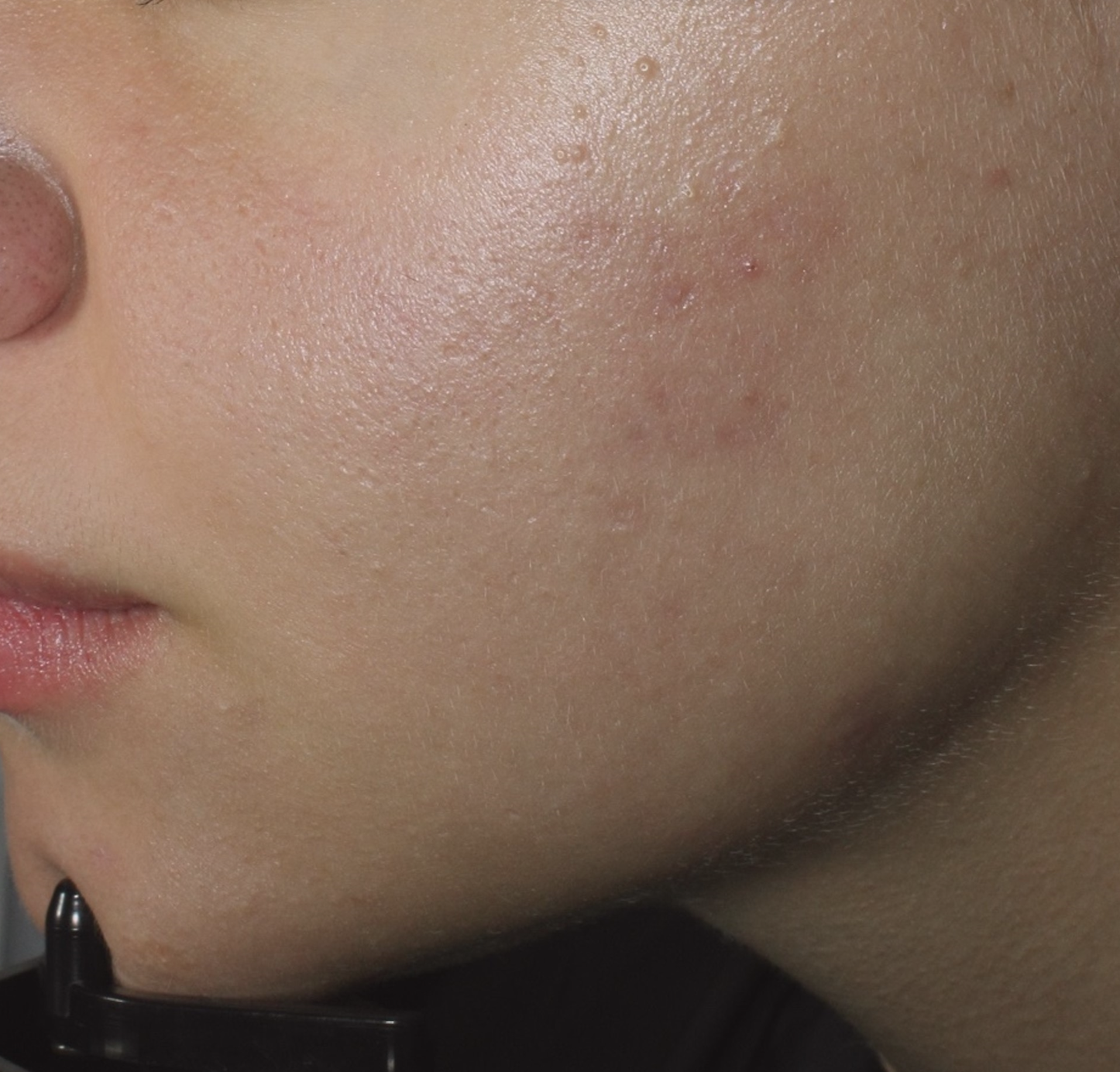 After treatment