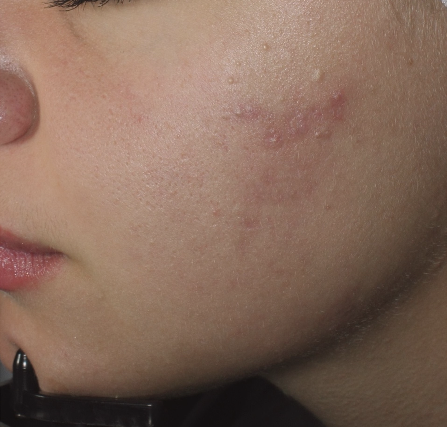 Before treatment
