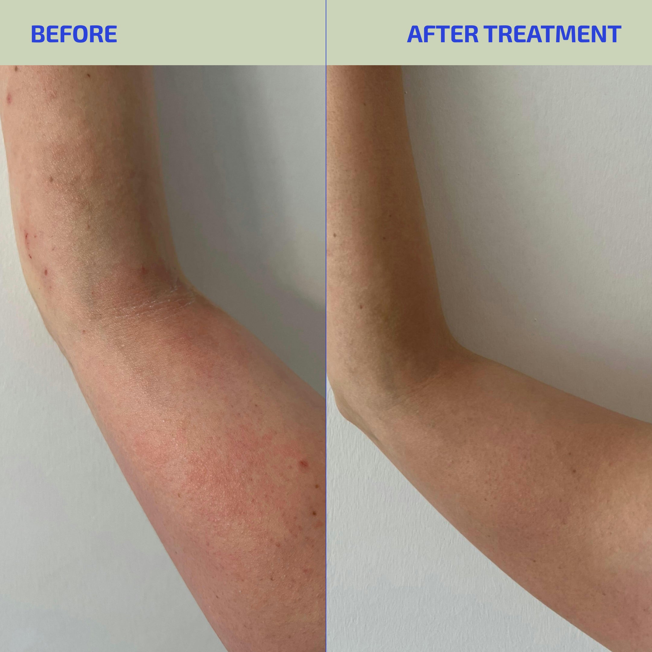 Before and after treatment comparison of an arm with visible skin improvement.