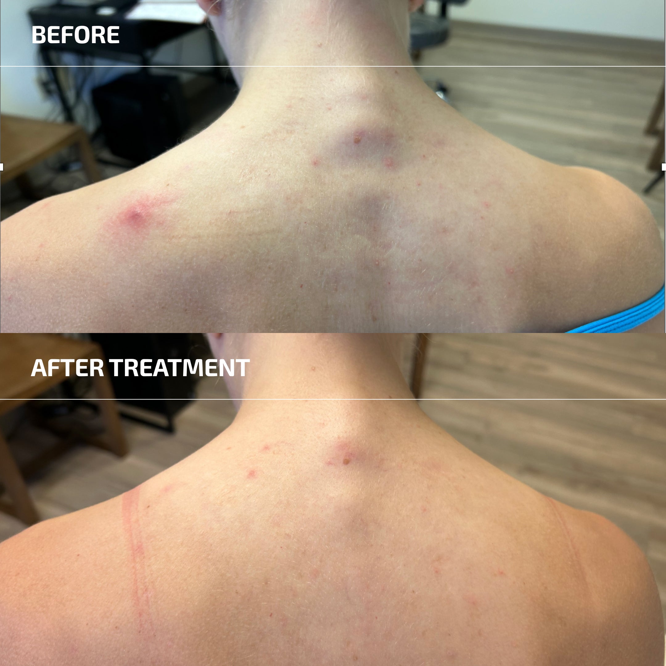Body Acne (Bacne) Protocol - Body Scrub, Spot Treatment & Probiotic (Age: 18-60+)