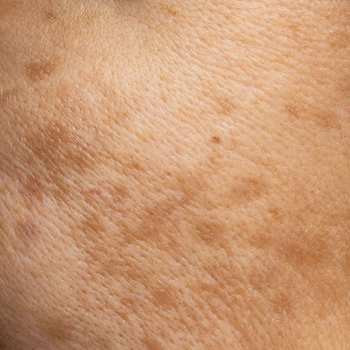 Menopausal Skin