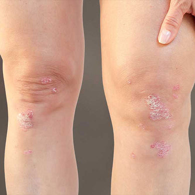 Psoriasis
