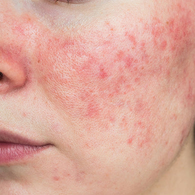 Rosacea