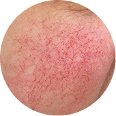 Erythematotelangiectatic Rosacea