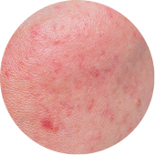 Papulopustular Rosacea 