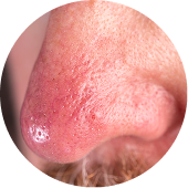 Phymatous Rosacea