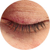OCULAR ROSACEA