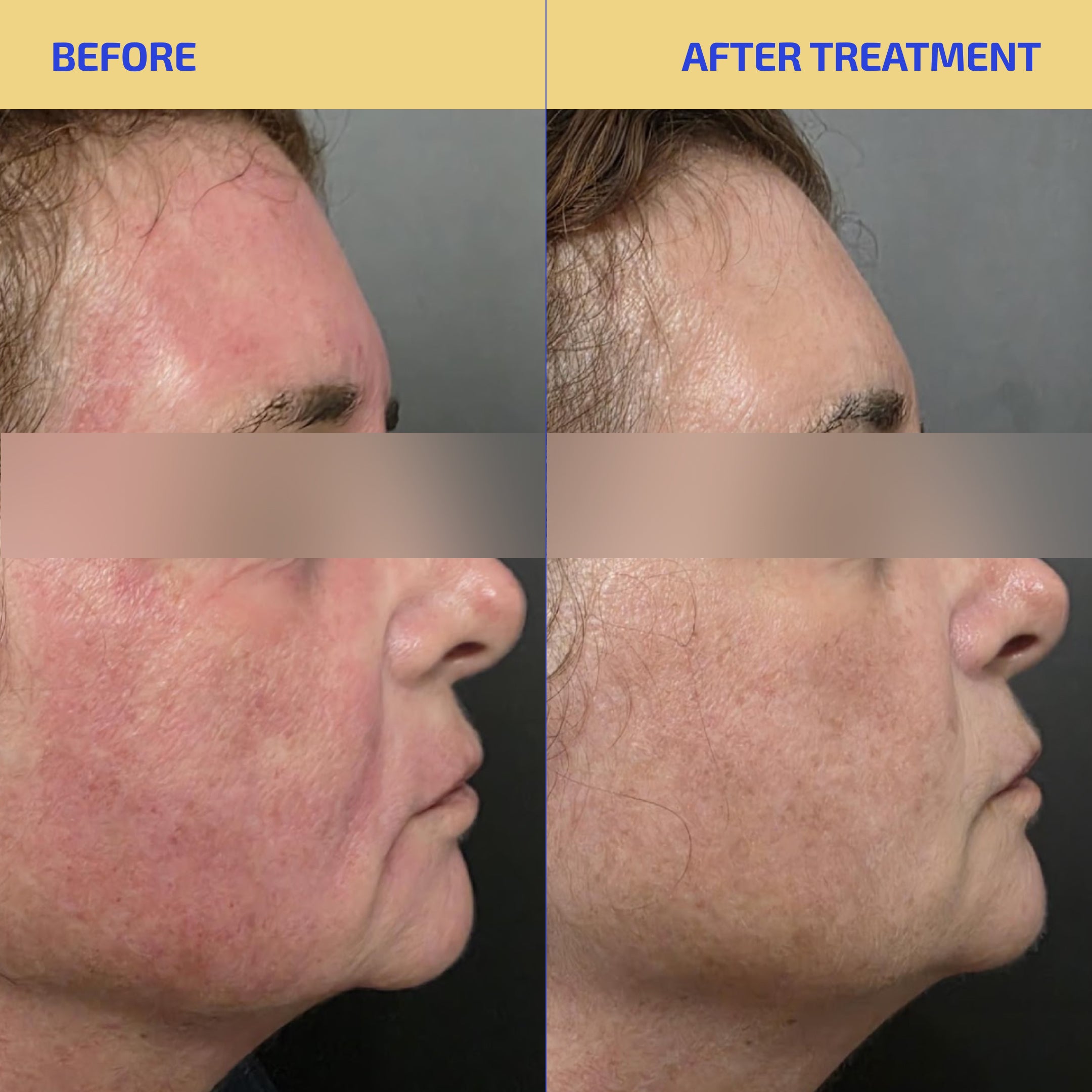 Comparison of a person's face after RF microneedling using Kangfu Gel or standard cream 