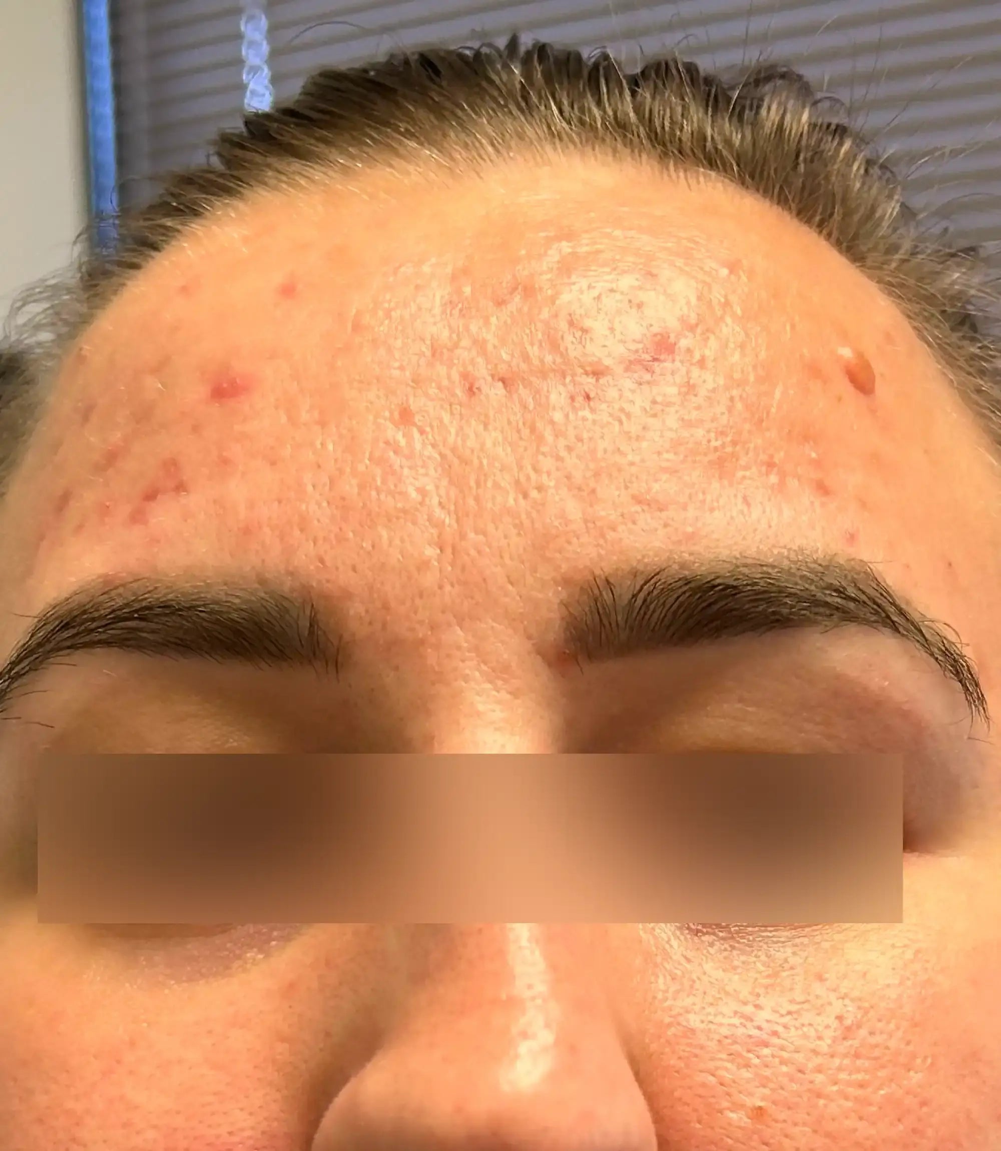 After treatment