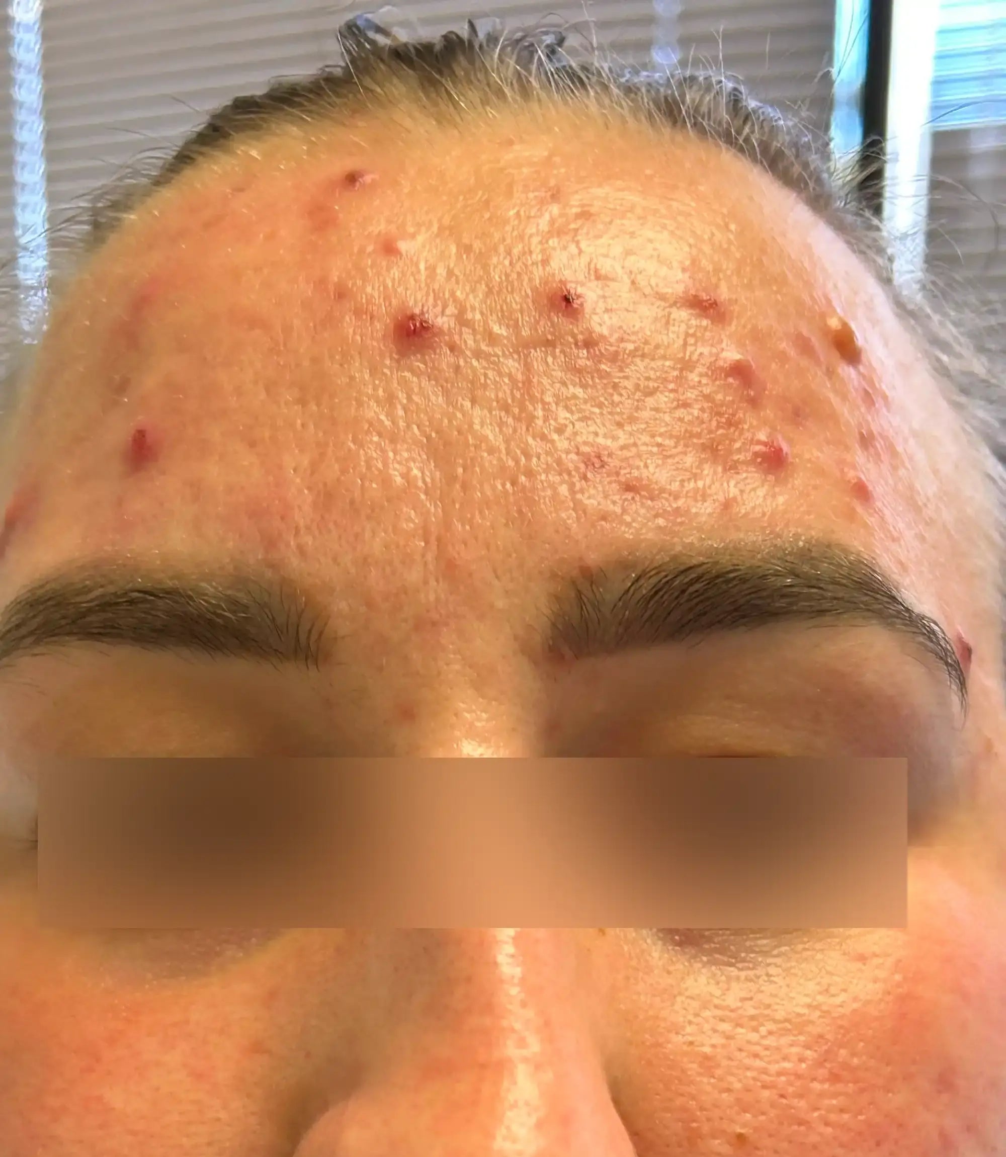 Before treatment