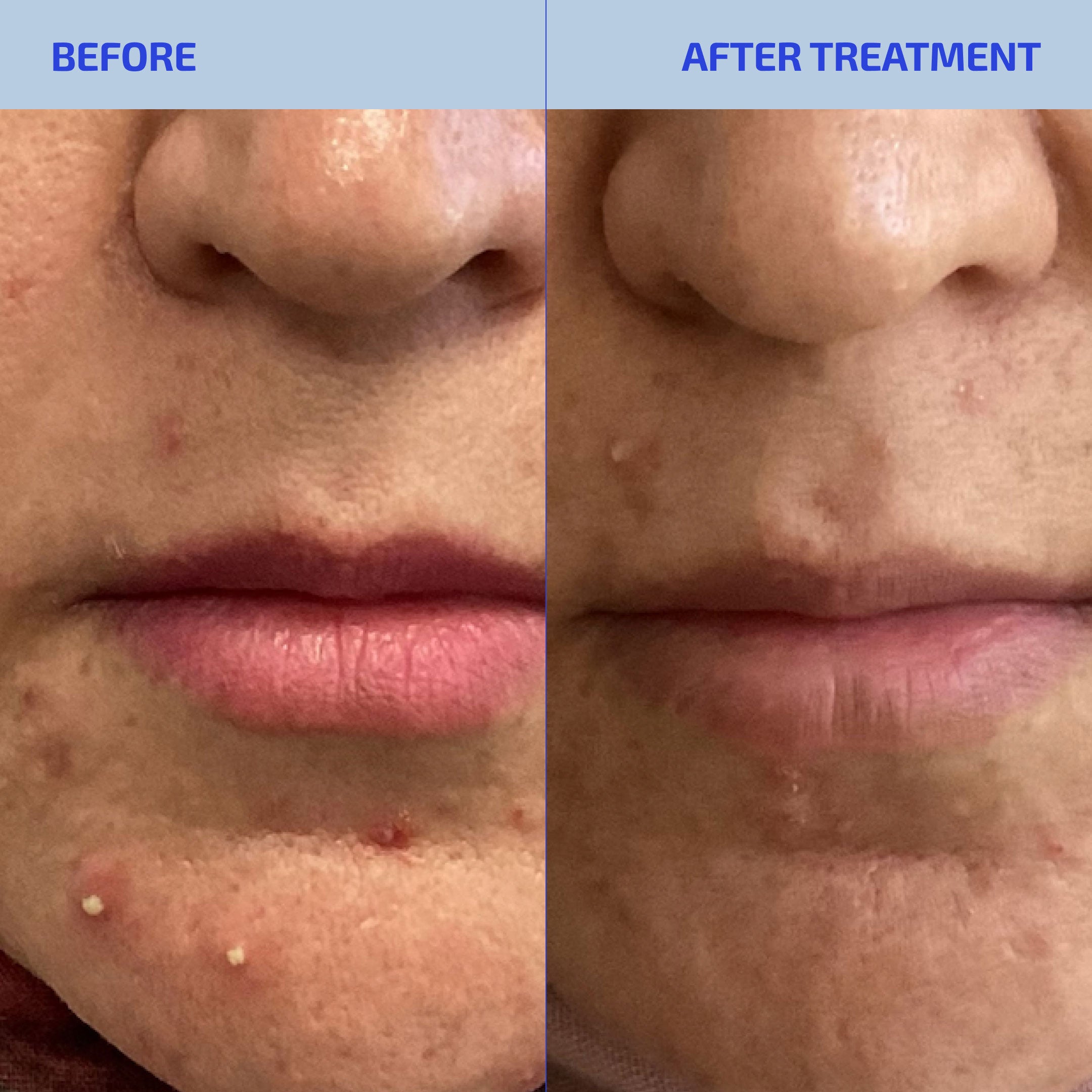 Before and after treatment comparison of skin on a person's face.