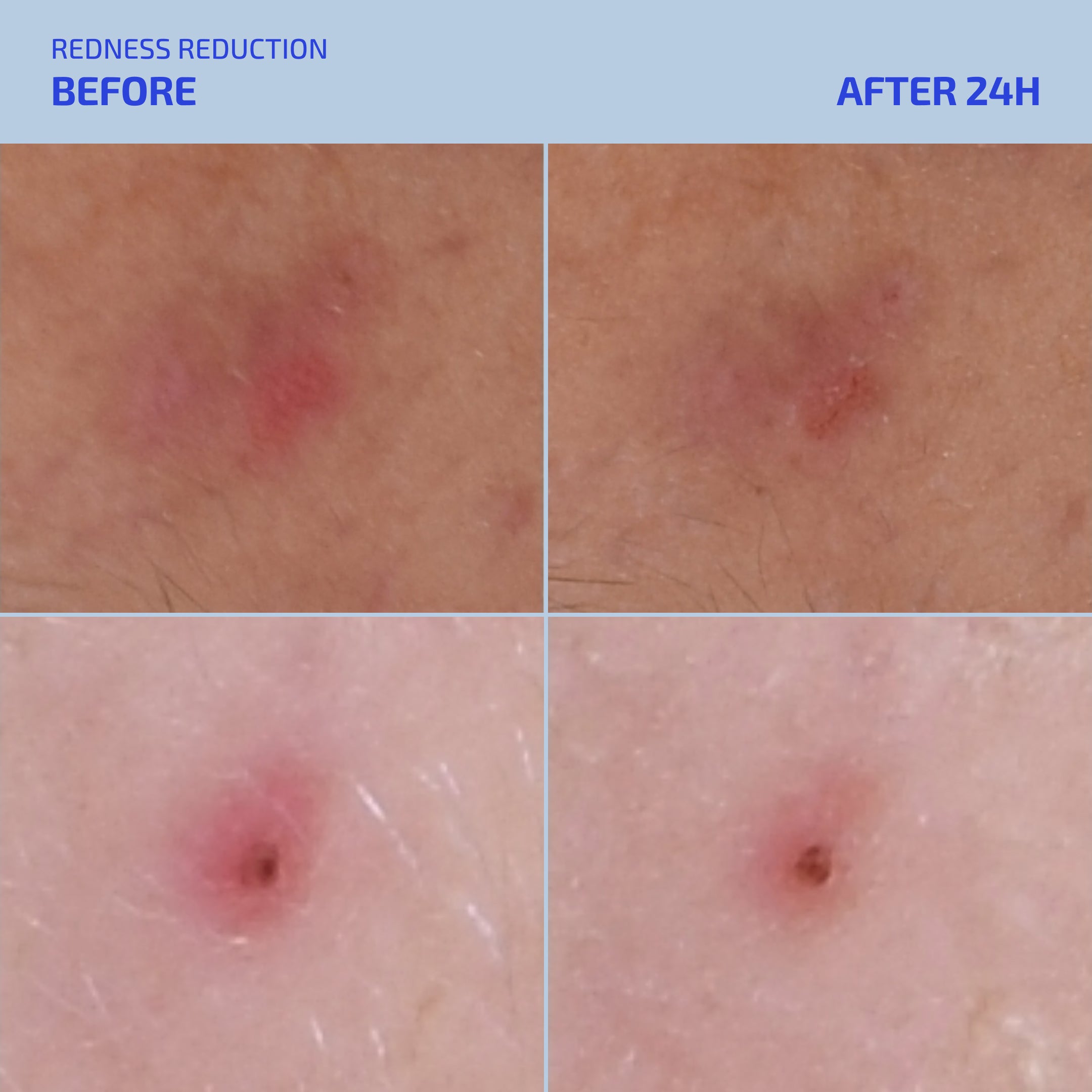 SHAANT Spot Hero Pimple Gel (12+)