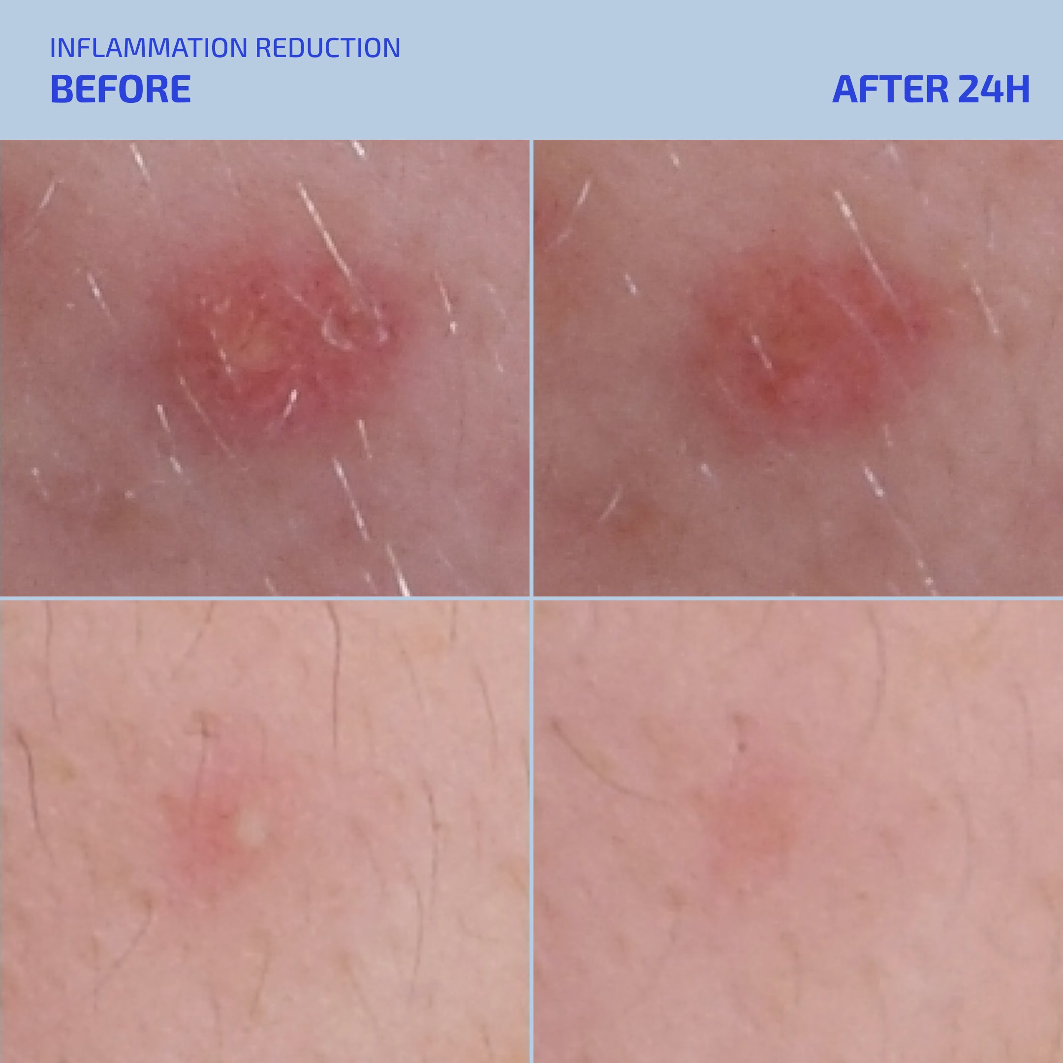 SHAANT Spot Hero Pimple Gel (12+)