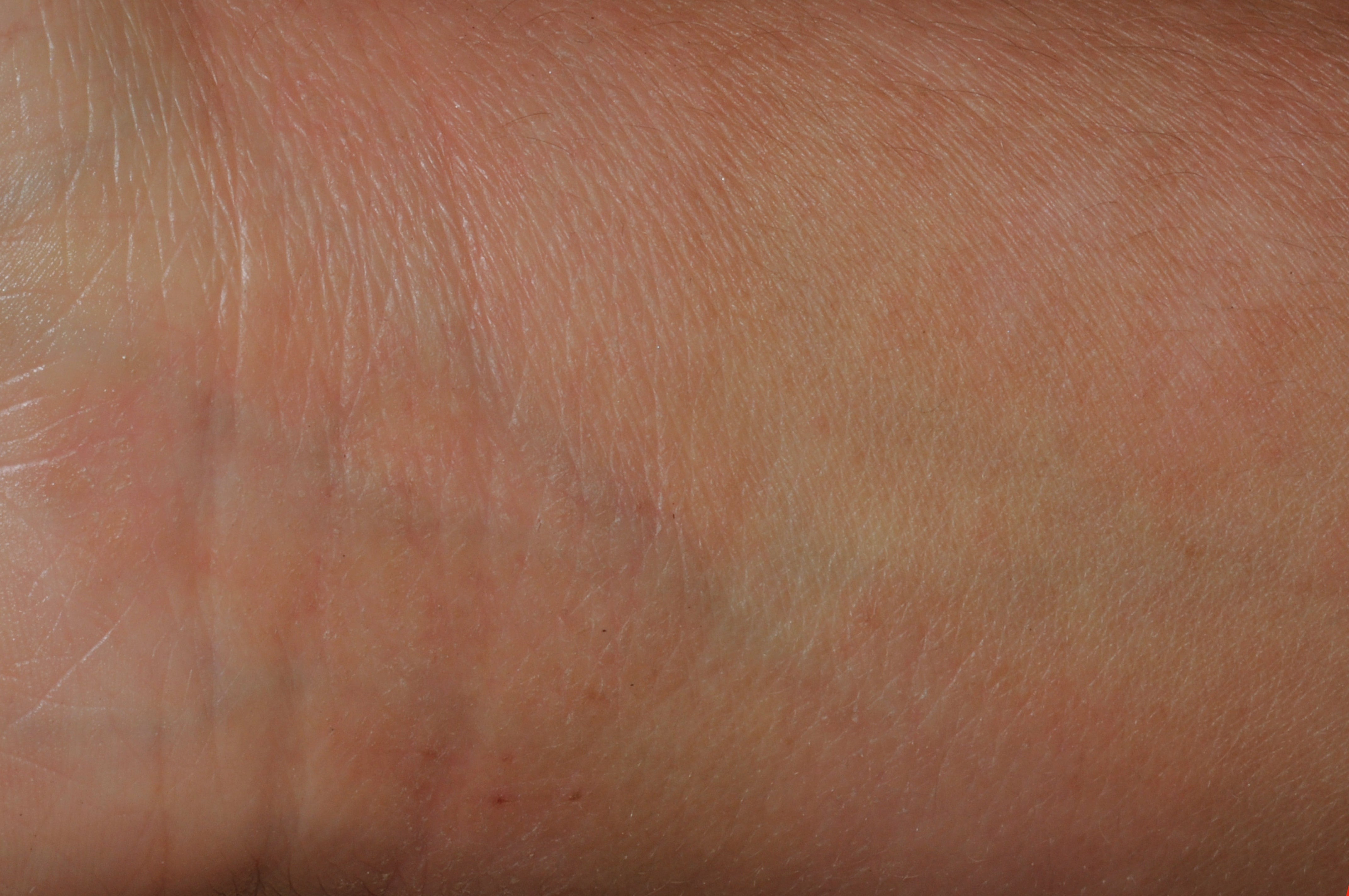 Before treatment