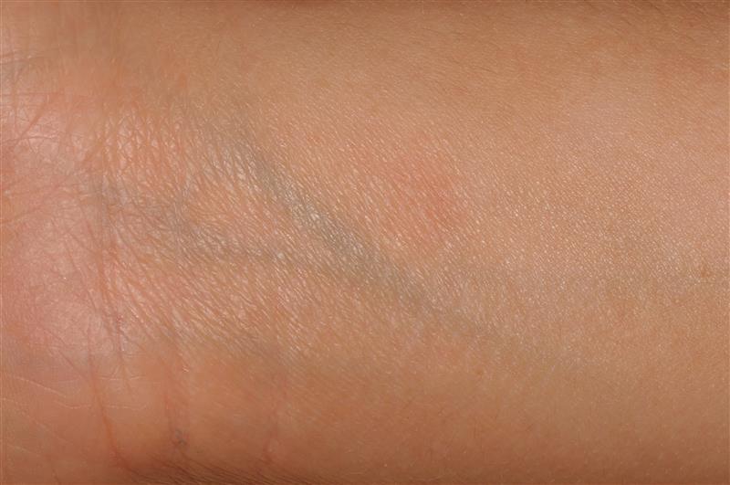 After treatment
