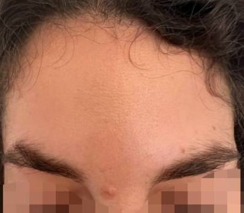 After treatment