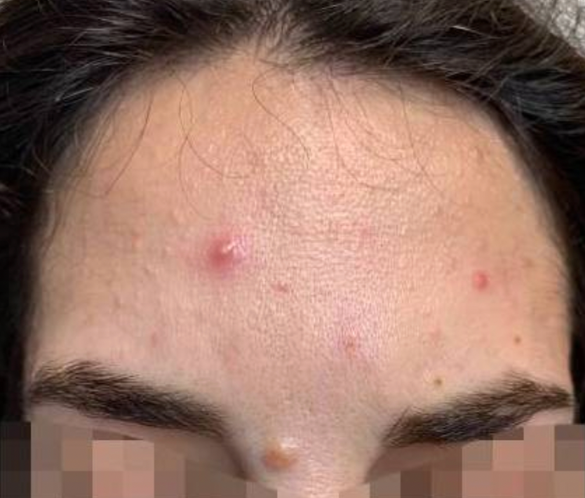 Before treatment