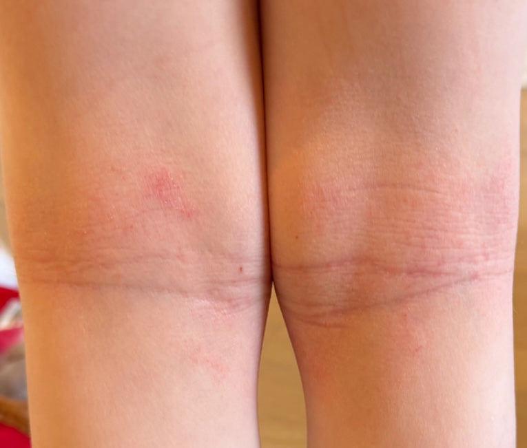 After treatment