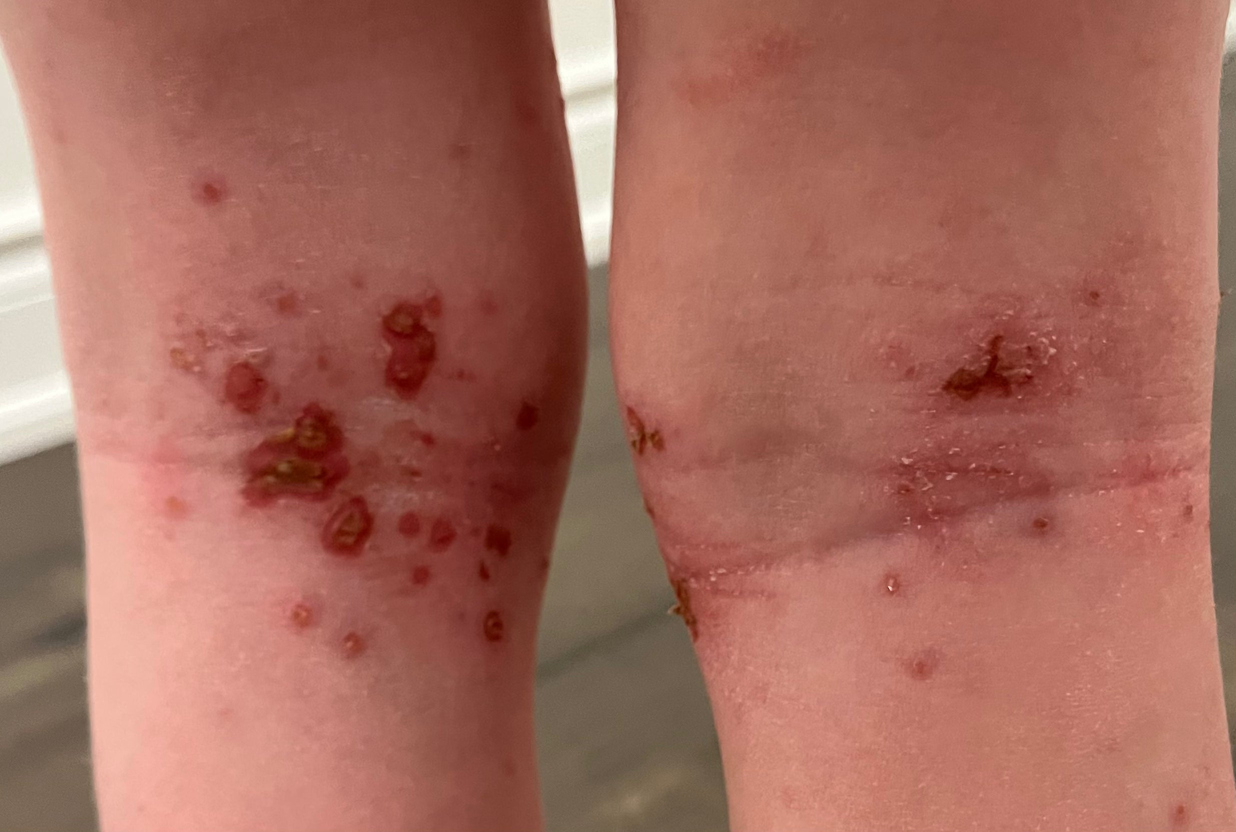 Before treatment