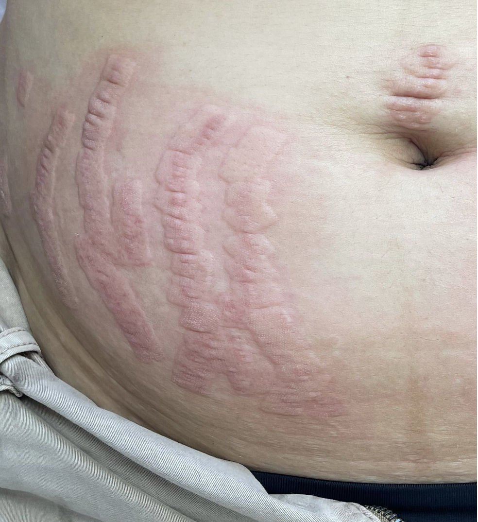 Before treatment