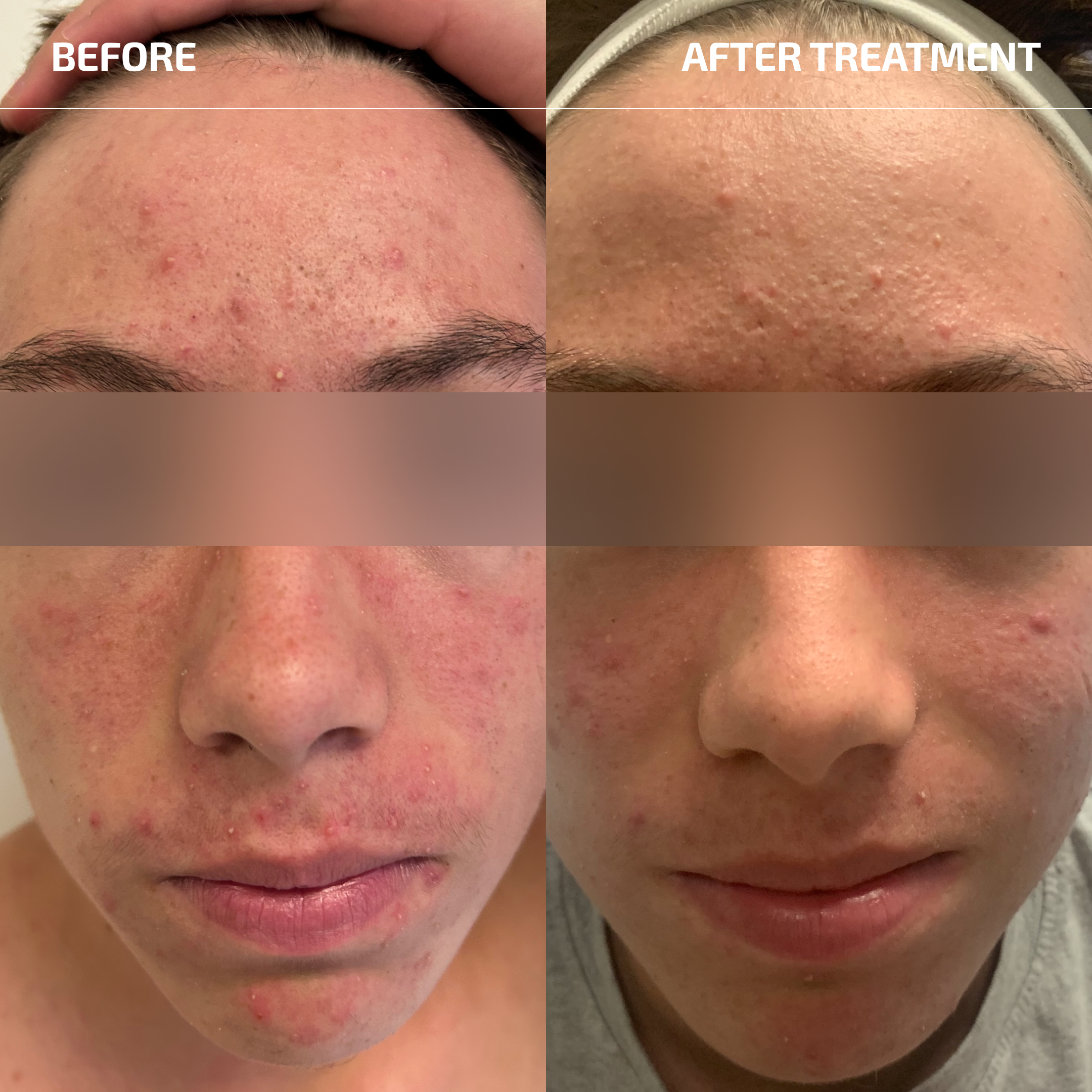 Sensitive Skin Acne System (18+ years)