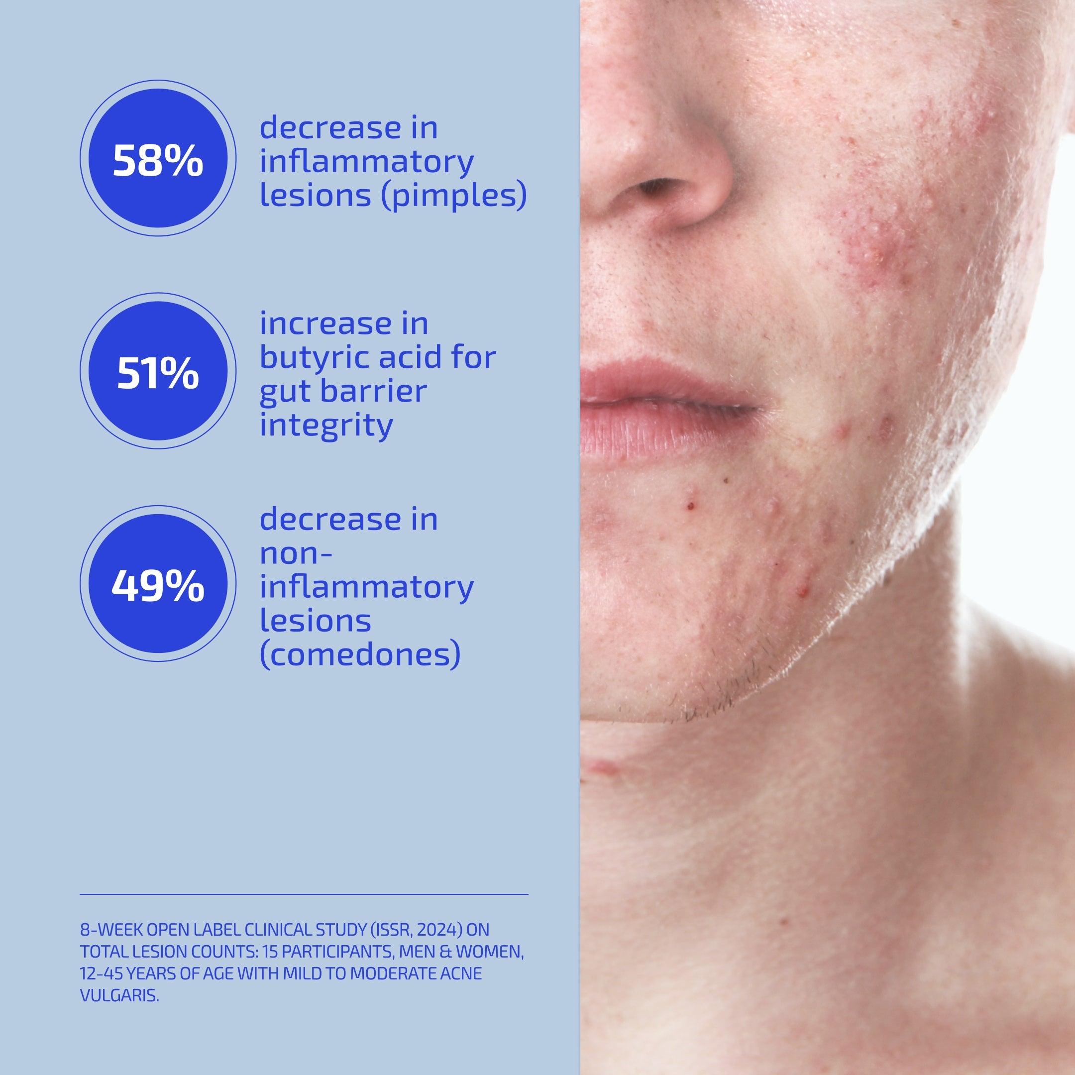 Hormonal Acne Treatment Protocol – Breakout Control with Salicylic Acid & Supplement (Age: 12-60+)